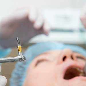 A dental implant surgery procedure