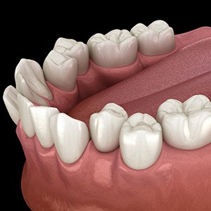 Illustration of crooked teeth
