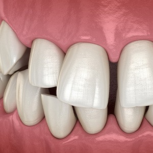 Illustration of gapped teeth