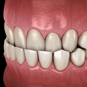Illustration of an underbite