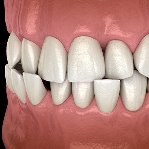 Illustration of a crossbite