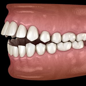 Illustration of an open bite