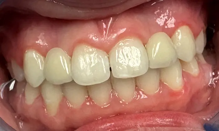 Smile with evenly colored and straighter teeth
