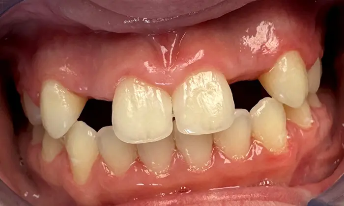 Smile with several stained and crooked teeth