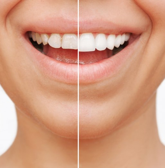 Before and after veneers