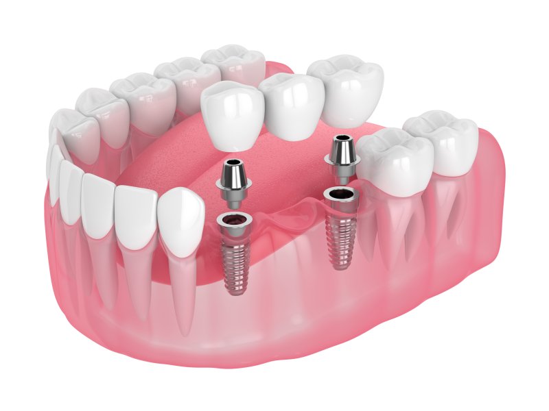 Exploded image of implant bridge