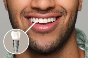 Man with a dental implant smiling